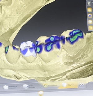 cerec scan of teeth