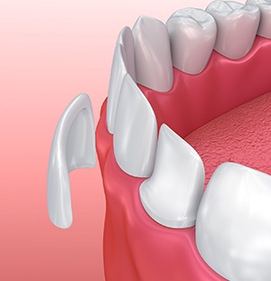 illustration of veneers