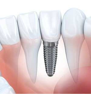 illustrated implant