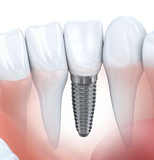 illustration of implant between teeth
