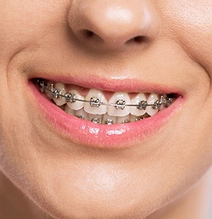 traditional metal braces