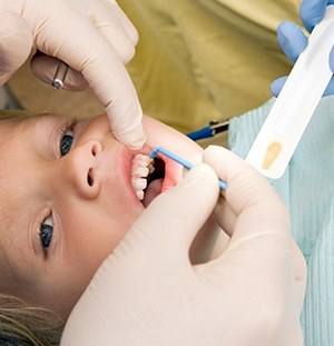 child getting fluoride treatments