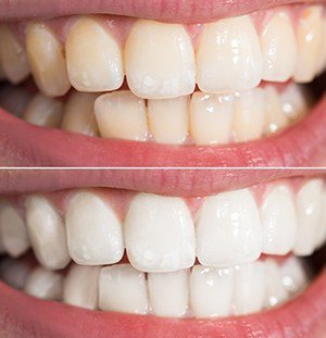 before and after whitening